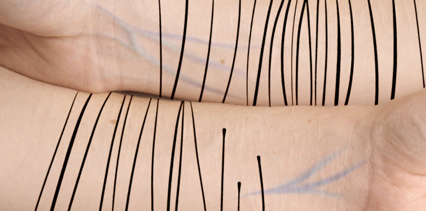 Scars